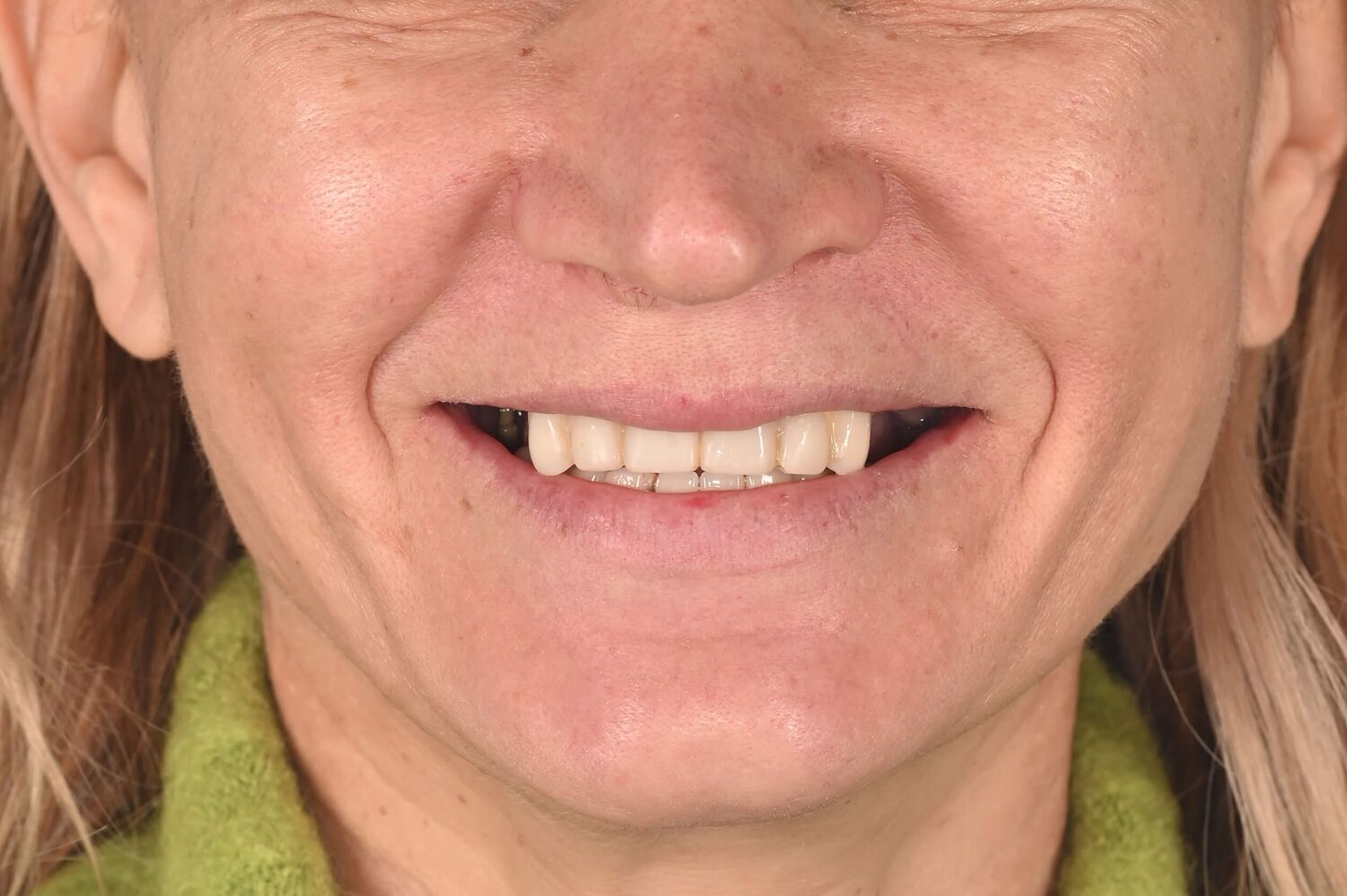 Pacient Clinica Dr. Alin Odor - Rezultat Implantologie